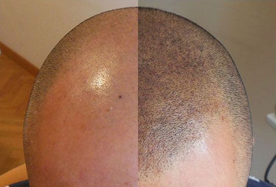 Tricopigmentación