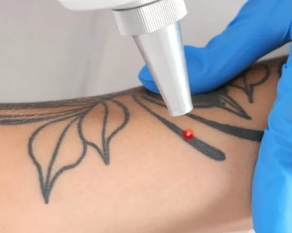 Eliminación de tatuajes:   láser Q-Switched y Removal para decir adiós a los tatuajes no deseados"