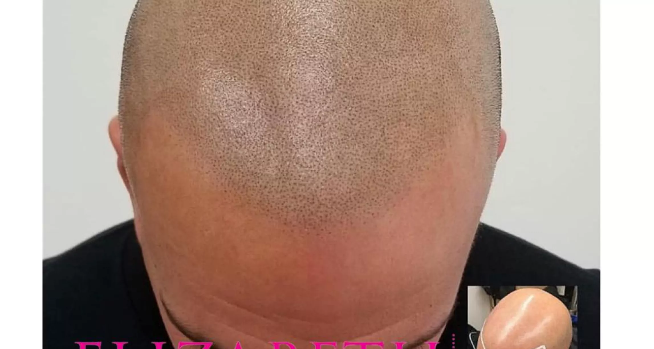 La micropigmentación capilar resulta ideal para aquellos pacientes que sufren procesos de caída de pelo irreversible o quieren tener mas densisdad